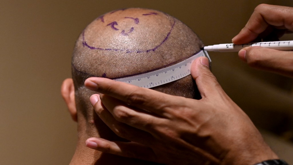 طبيب يضع علامات على  رأس مريض قبل زراعة الشعر في عيادة كراون في نيودلهي.5 نوفمبر 2022.(أ ف ب)