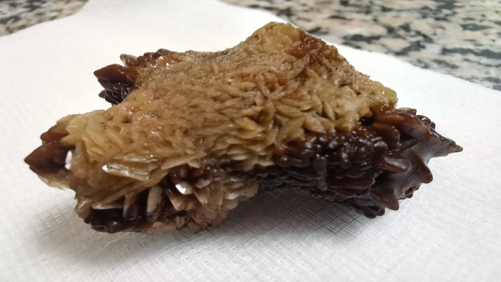 استخراج حصوة كبيرة من الكلى باستخدام المنظار في مأدبا.