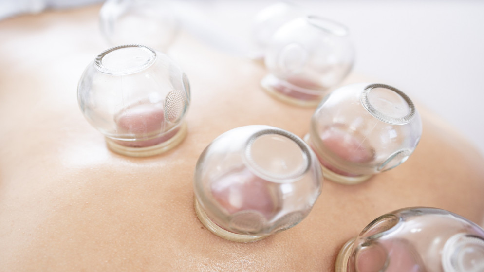 صورة توضيحية لمعالج بالحجامة. (Istockphoto)
