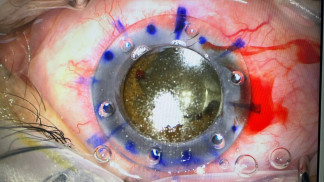 عملية نوعية لمريض في مقلة العين بمستشفى الملك المؤسس